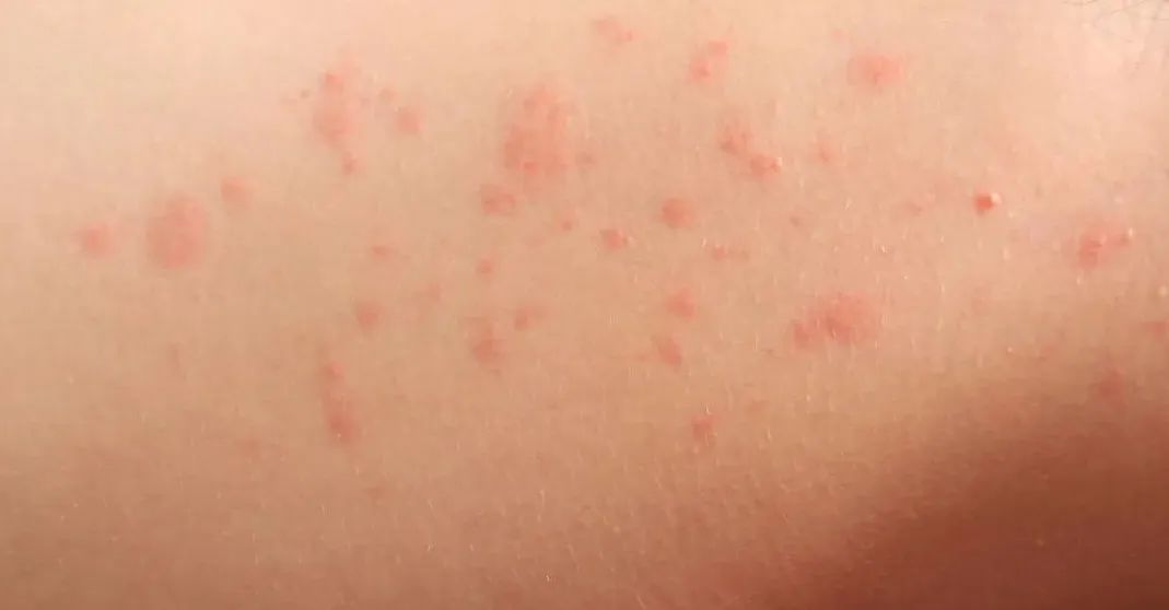 为什么耳洞这么容易发炎,天生耳洞发炎最佳处理方法