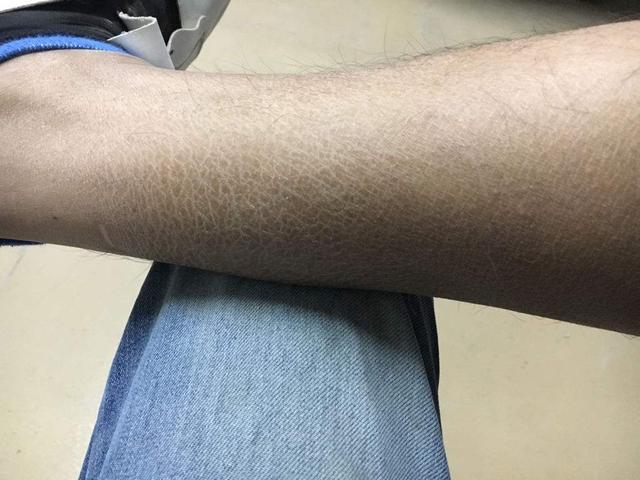 冬天皮肤干燥皮屑满天飞吃什么药,秋衣秋裤皮屑满天飞