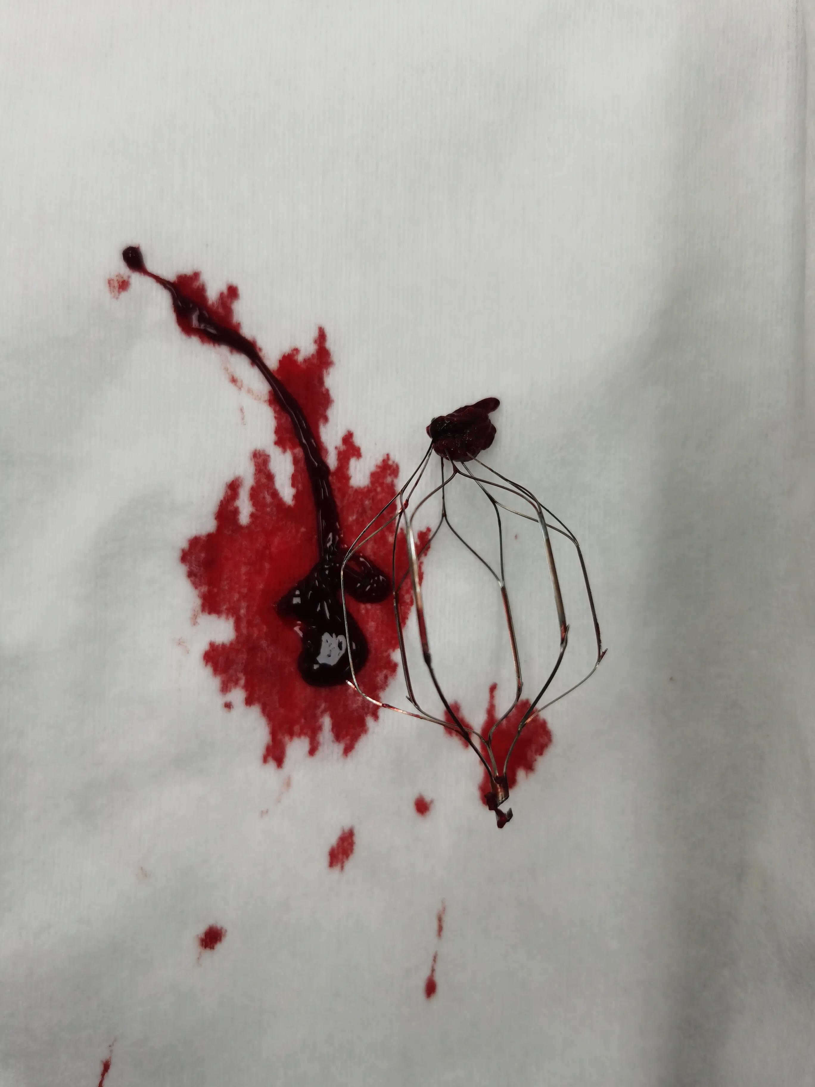 一到下午就腿肿什么原因怎么治疗,腿肿是什么病的前兆怎么治疗