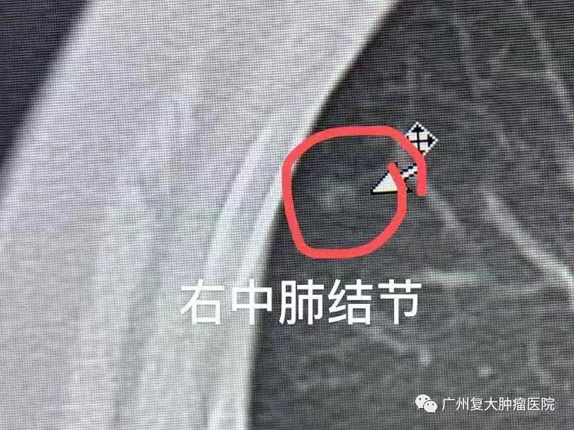 肺结节该观察还是手术？或许微创消融治疗是个不错的选择