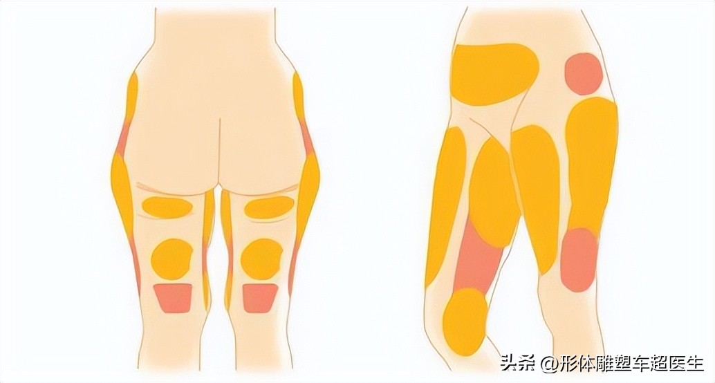 吸脂之后凹凸不平是怎么回事,吸脂后凹凸不平怎么消除