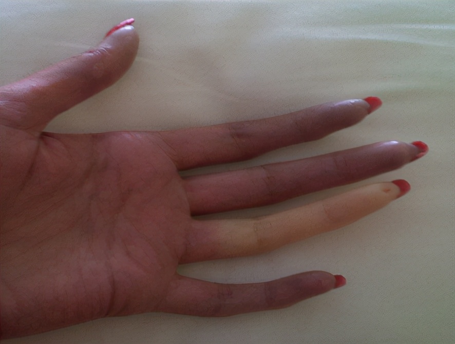 伟哥可以治疗的疾病,伟哥原来是用来治疗什么疾病