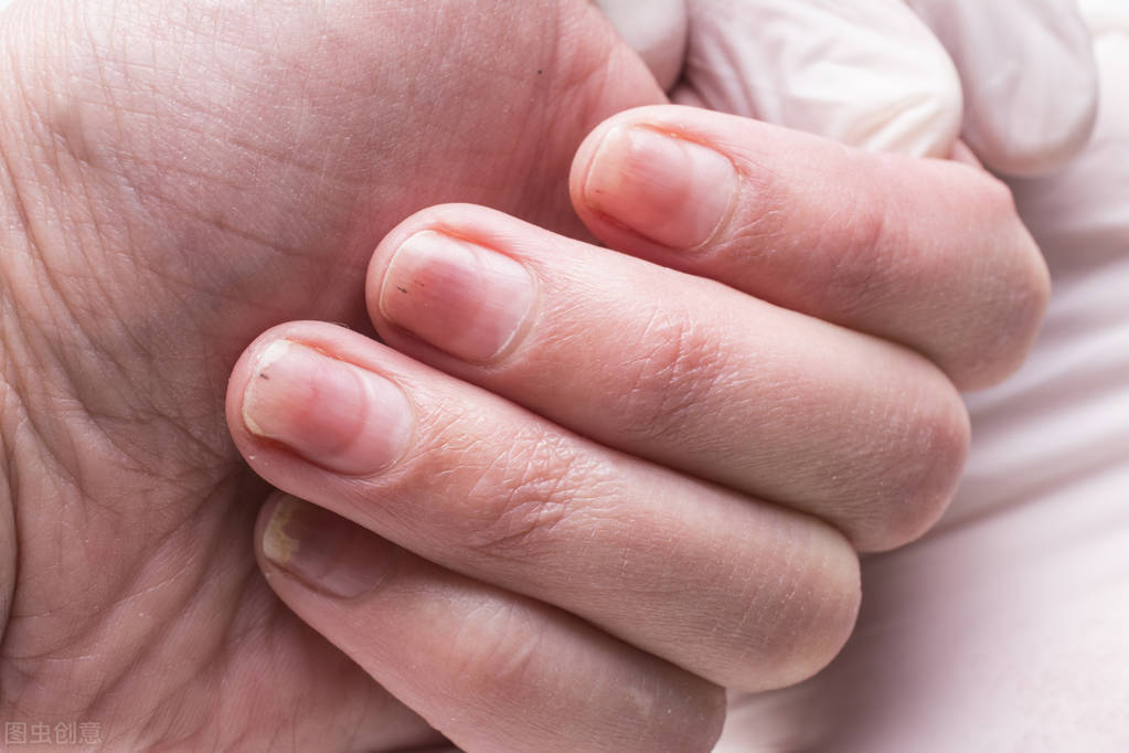 灰指甲烂到根部不治疗有什么危害,治灰指甲的药弄到皮肤上有危害吗