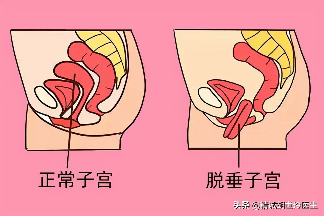 盆底肌无力适合顺产吗,盆底肌未恢复可以怀孕吗
