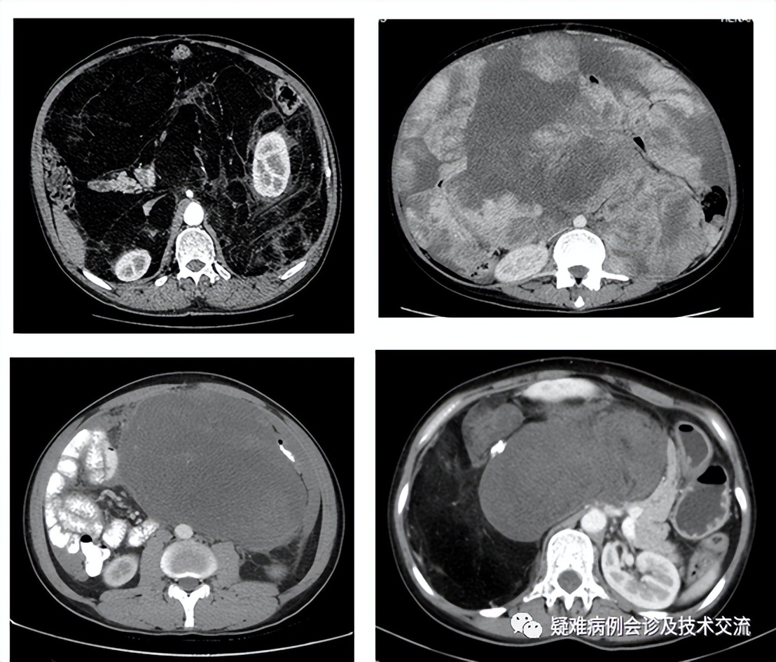 腹膜脂肪肉瘤治愈案例,原发性腹膜后脂肪肉瘤的综合治疗