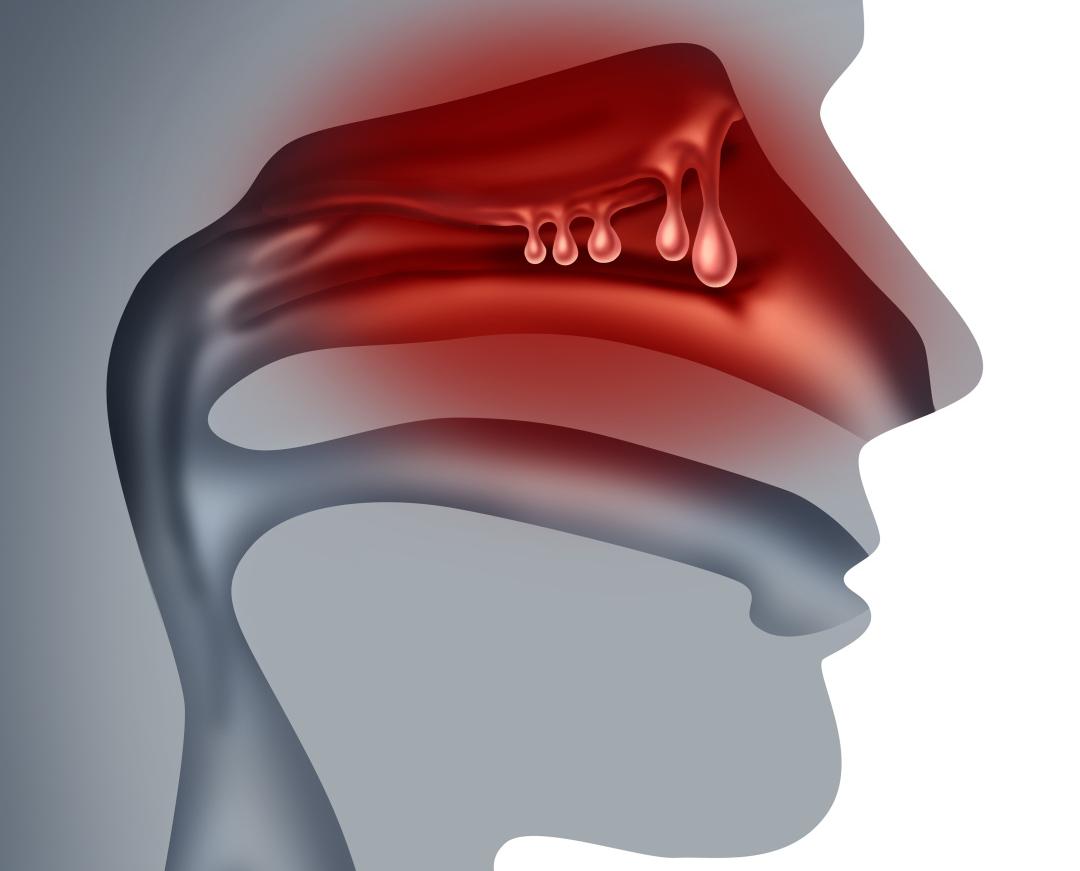 息肉到癌仅一步之遥？专家：有1种发现后要马上切