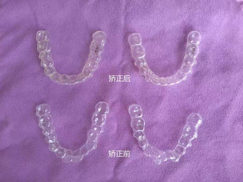 整牙亲身经历分享一下,整牙的经历分享