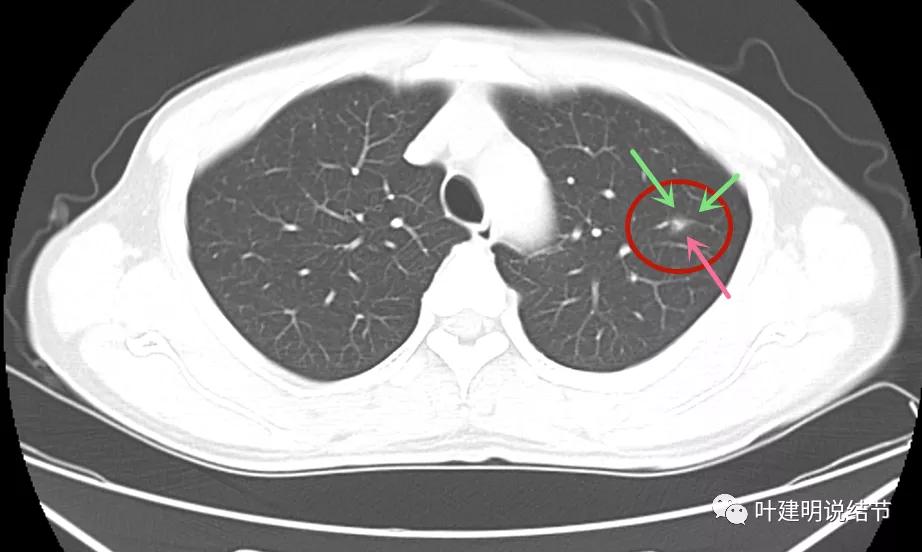 这样的多发病灶给试验性抗结核治疗?消失的结节是药的功劳吗?