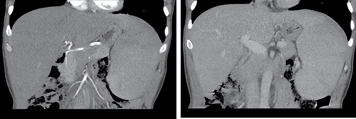 非肝硬化门脉高压是怎么回事,黑热病为什么会导致肝脾肿大