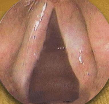 息肉一定会癌症吗,增生息肉切完会癌变吗