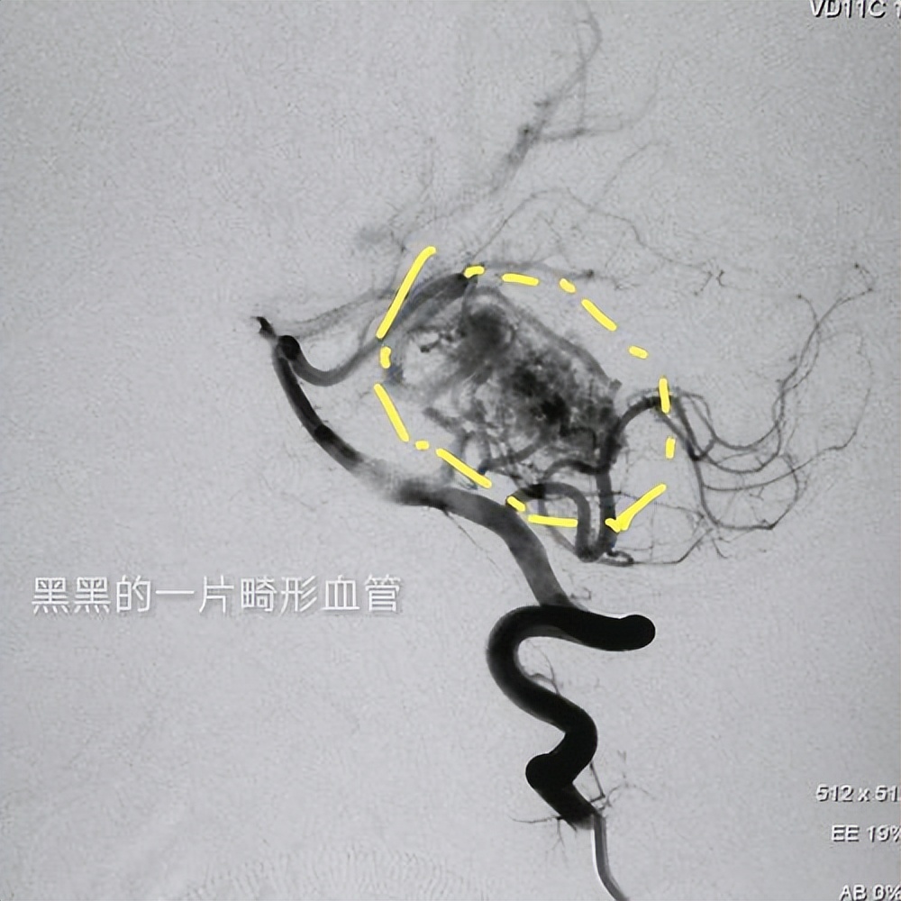 医生在患者清醒下进行开颅,脑子进血开颅手术