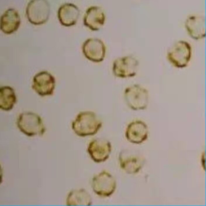 前列腺常规检查报告单正常,前列腺核磁共振报告单怎么解读