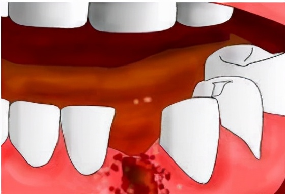 鎷旂墮鍚庢敞鎰忎簨椤瑰彲浠ユ娊鐑熷悧,鎷旂墮鍚庢敞鎰忎簨椤逛笌绂佸繉椋熺墿