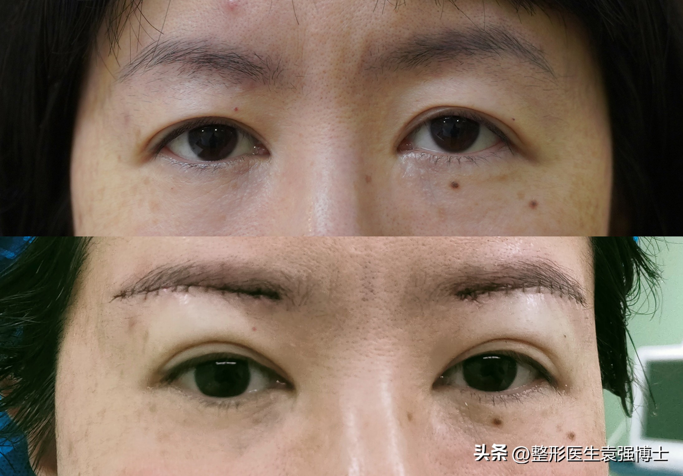 如何解决眼周衰老症状,眼周肌肤出现衰老怎么办