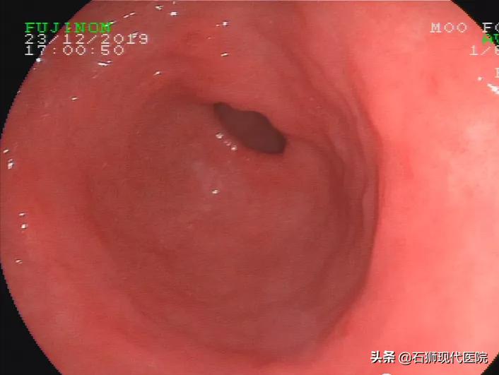 石狮医院有无痛胃镜吗,有哪些人不合适做胃镜