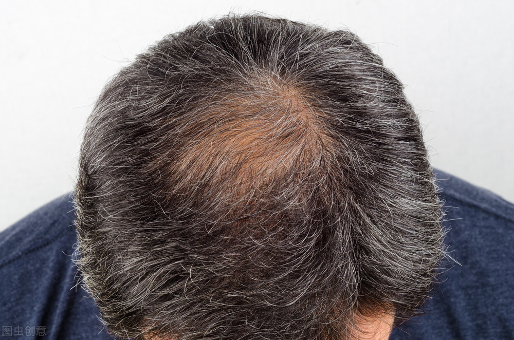 肝肾同补的中成药治疗脱发白发,滋补肝肾治白发的药