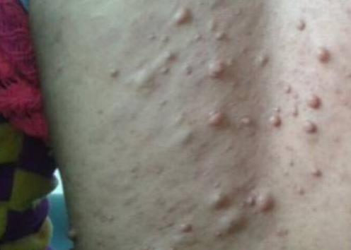 脂肪瘤切了又长应该手术么?听听医生怎么说病根是什么