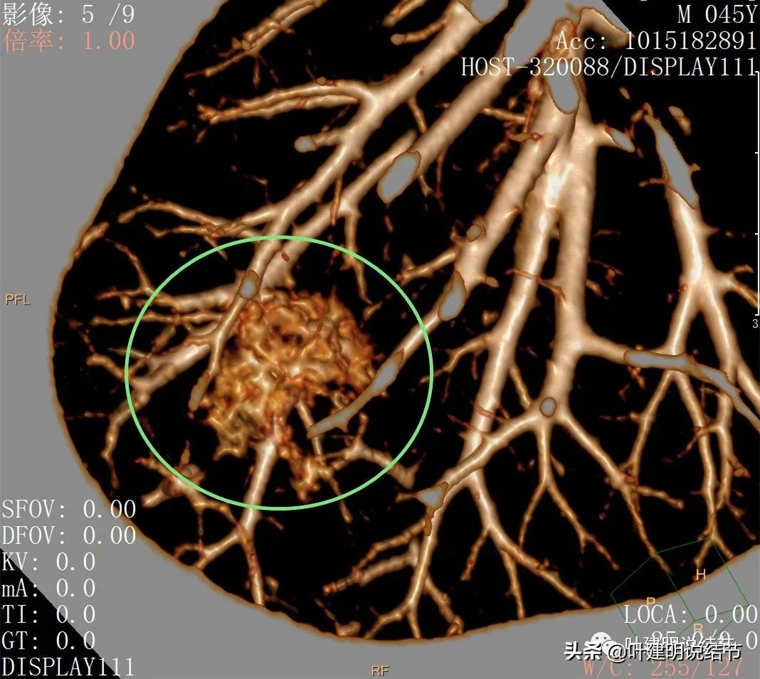 误诊肺纤维化,肺蜂窝状是癌吗
