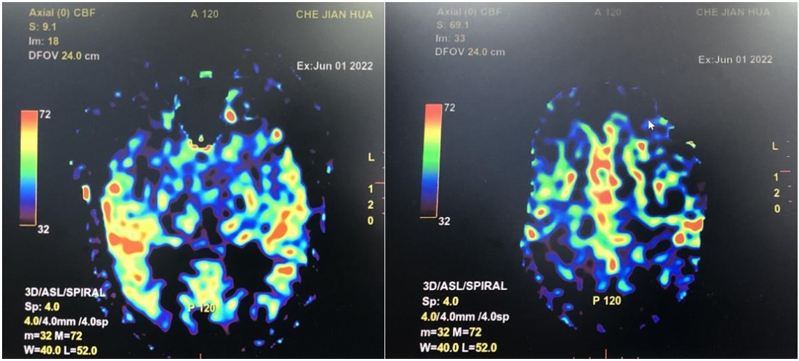 左侧大脑中动脉重度狭窄手术过程,颅内动脉重度狭窄能做手术吗