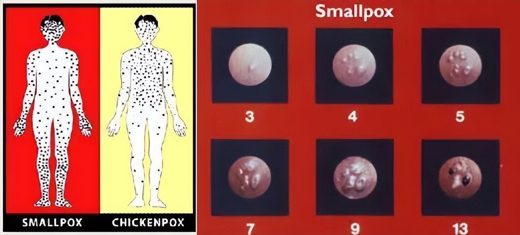 11个国家发现80多例猴痘，中国是否需要补种天花疫苗？