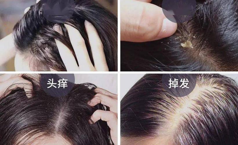 头皮长疙瘩怎么回事怎么解决,头皮上长疙瘩怎么治疗彻底