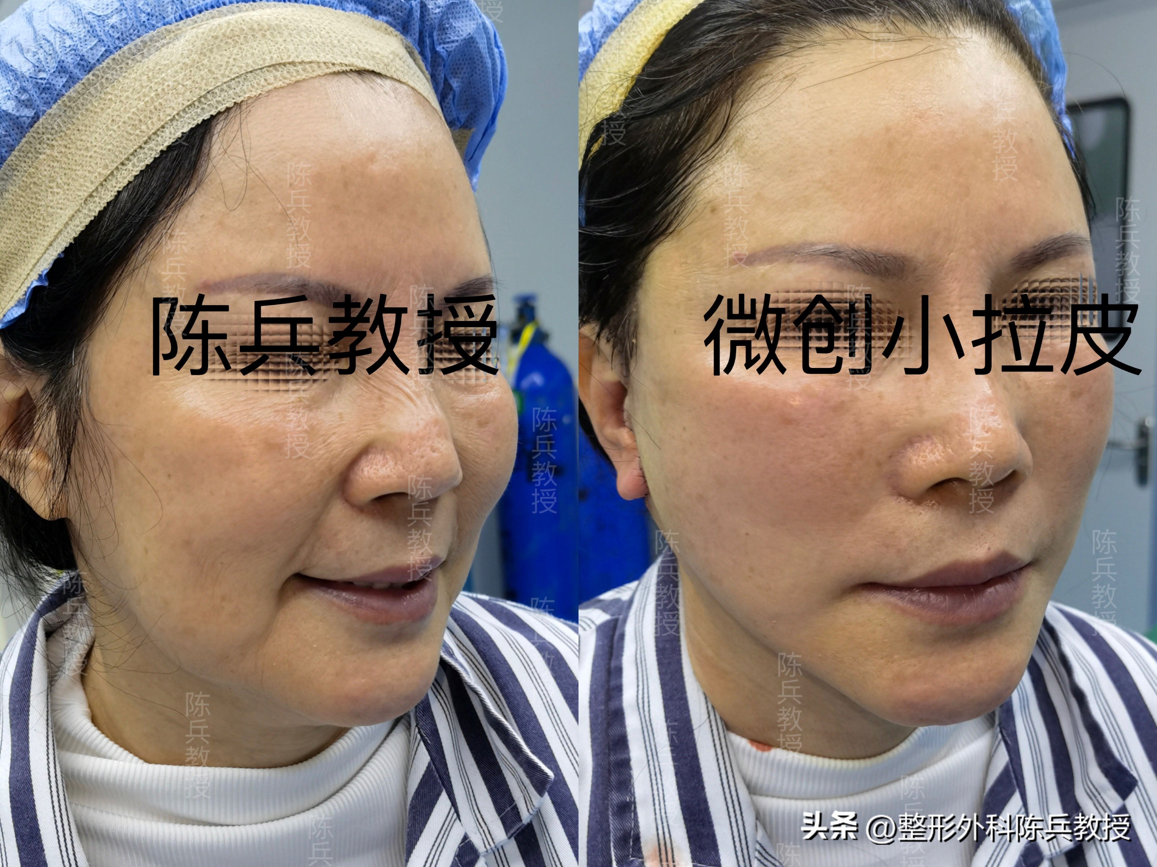 大拉皮和小拉皮哪个效果好,大拉皮跟小拉皮的区别是什么