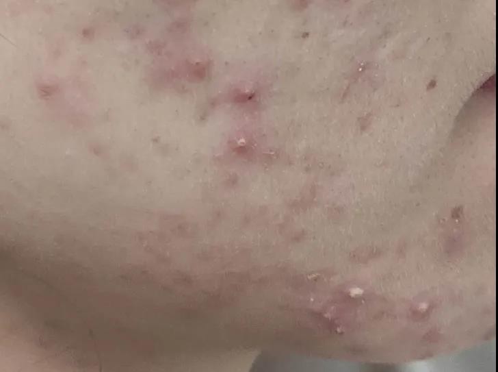 痘痘肌的十大内调方法,痘痘肌要怎么内调