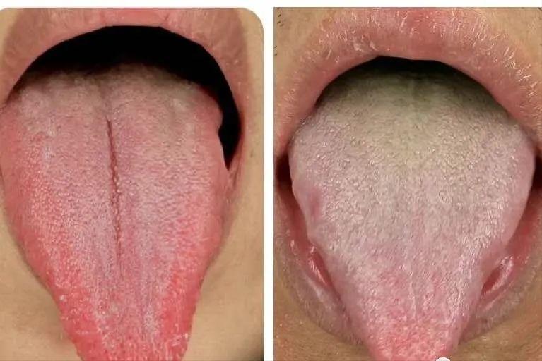 舌诊辨证和精准用药,中医诊病无需诊脉和观舌象靠谱不