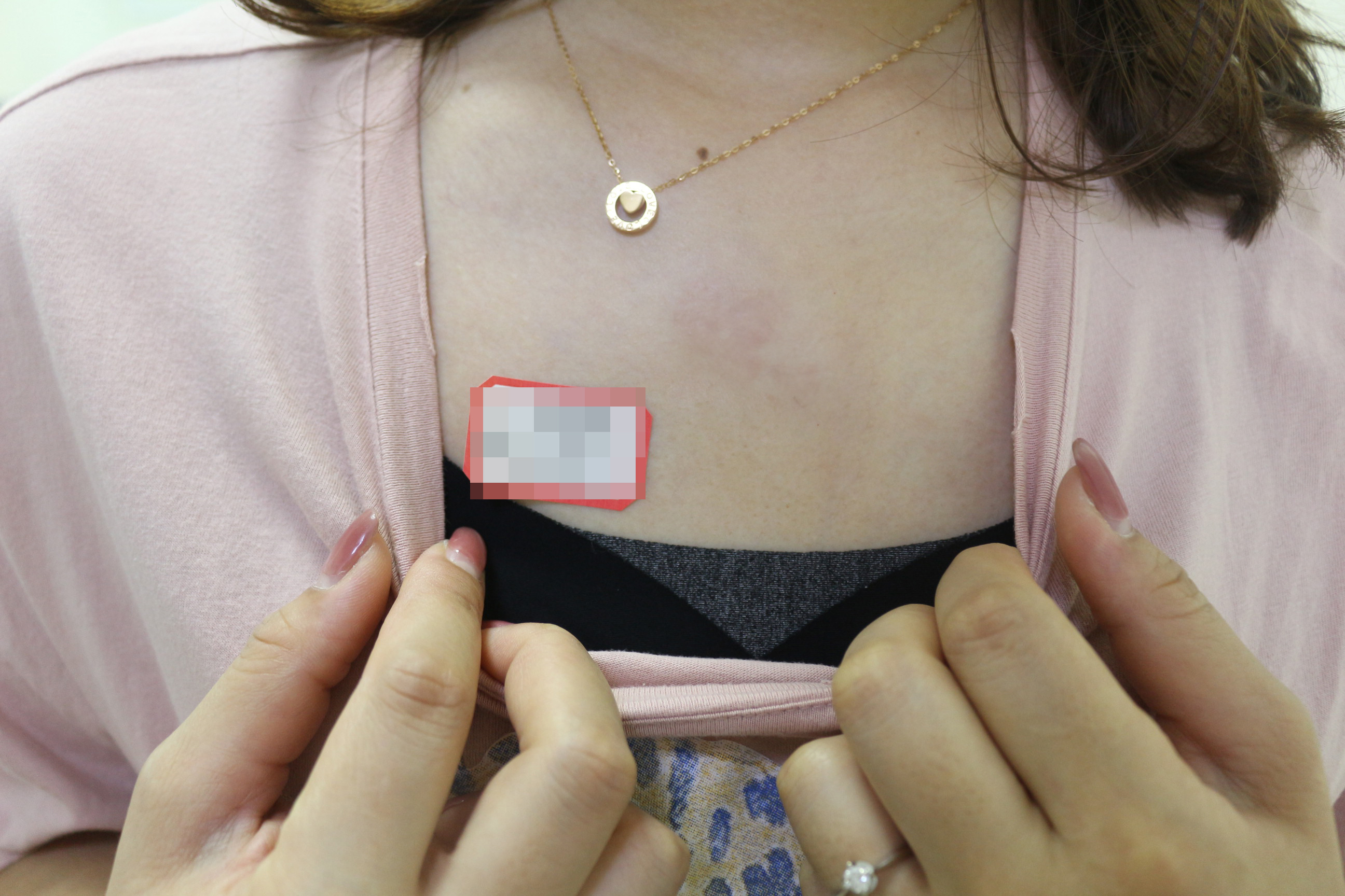 郑州胸前疤痕疙瘩修复医院,郑州第二中医院治疤痕疙瘩靠谱吗