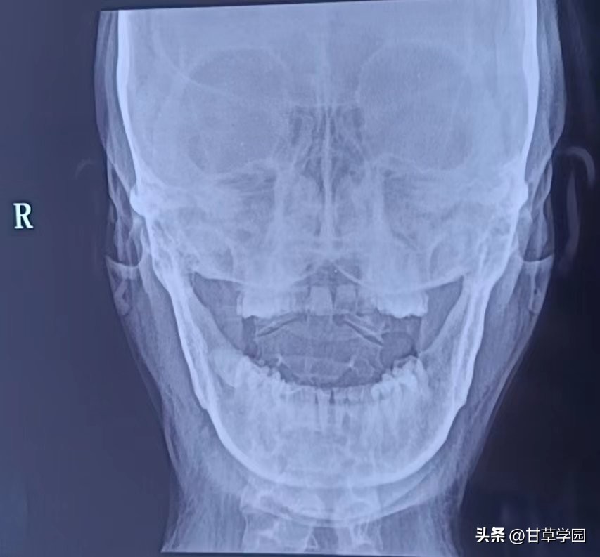 甘草学园|颈椎S型错位头晕焦虑案