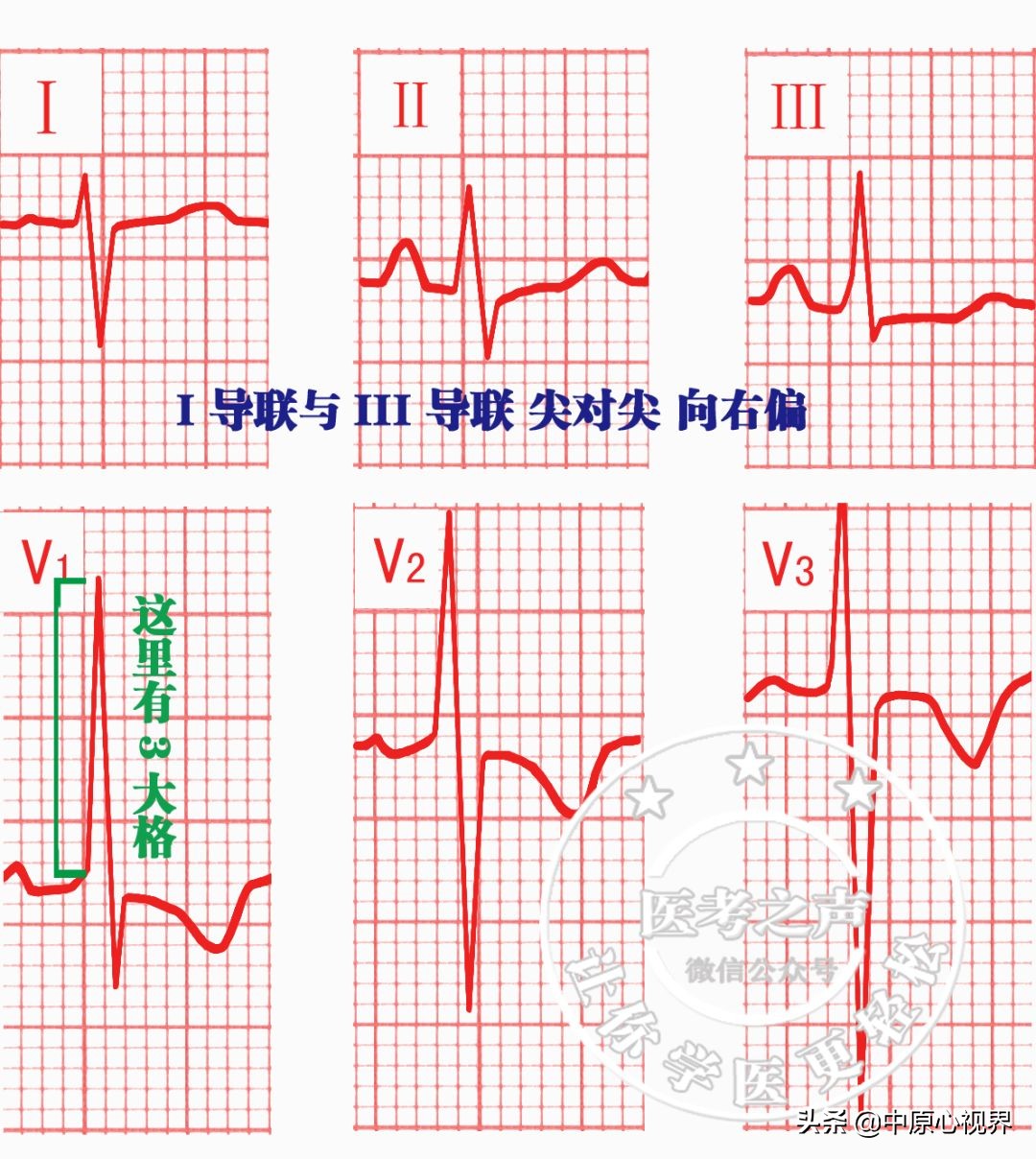 护考几种常见的心电图,常见的心电图图形分析