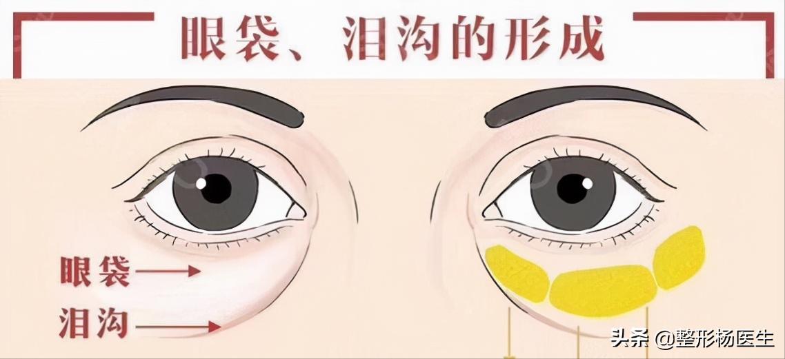 眼袋手术后真的显年轻吗,割眼袋能年轻几岁