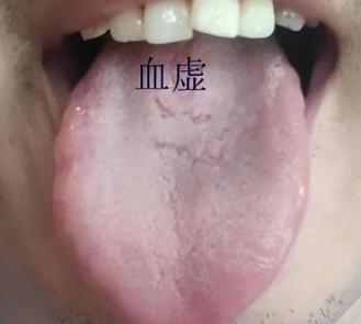 舌根部有裂纹是什么舌象,舌有裂纹7种原因通过舌象来调理