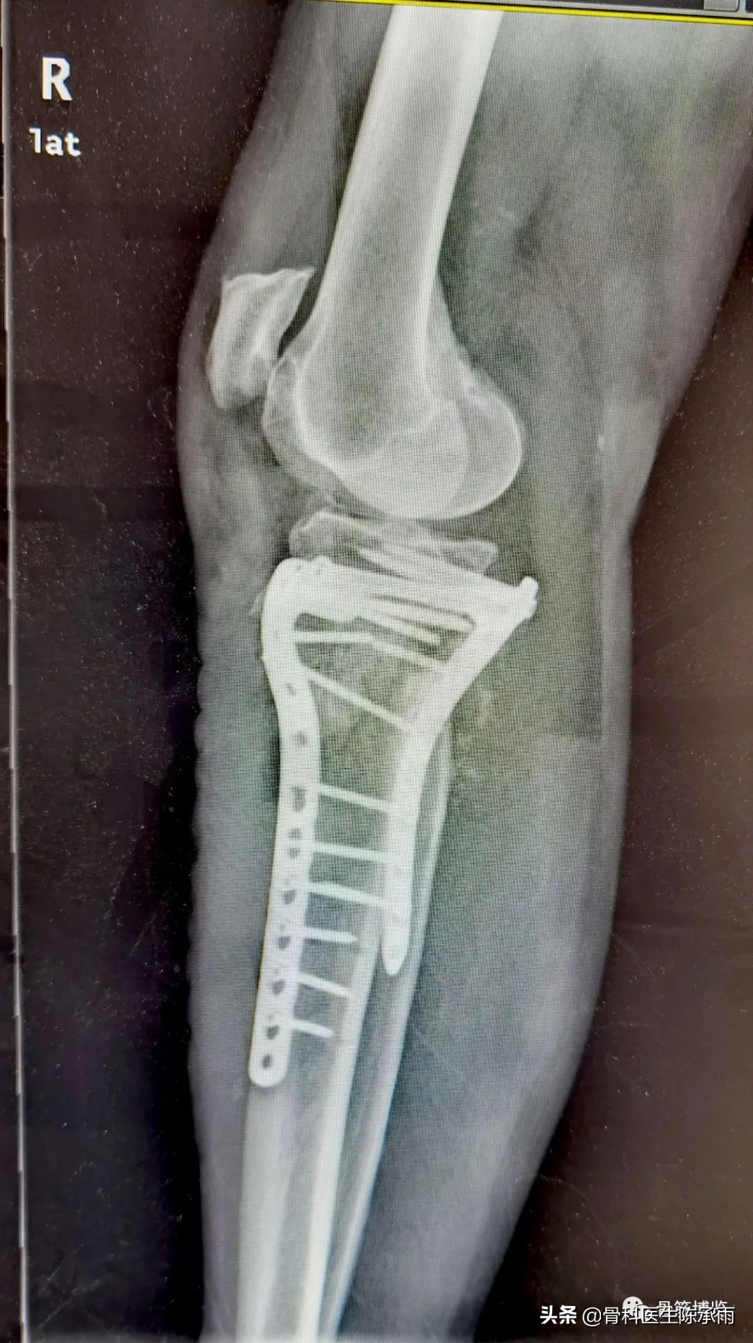 陈旧性腿骨骨折,陈旧性骨折