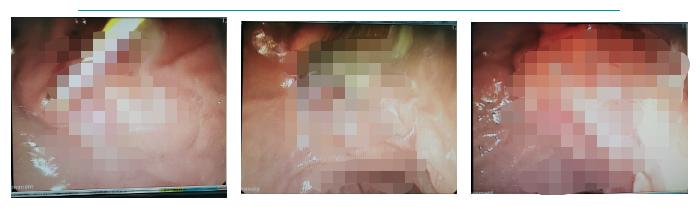 ercp手术后胆管发炎,化脓性胆管炎指南