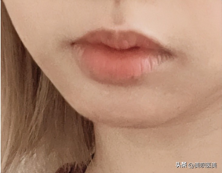 玻尿酸大分子能打脸吗,网红玻尿酸真的能改变肌肤吗