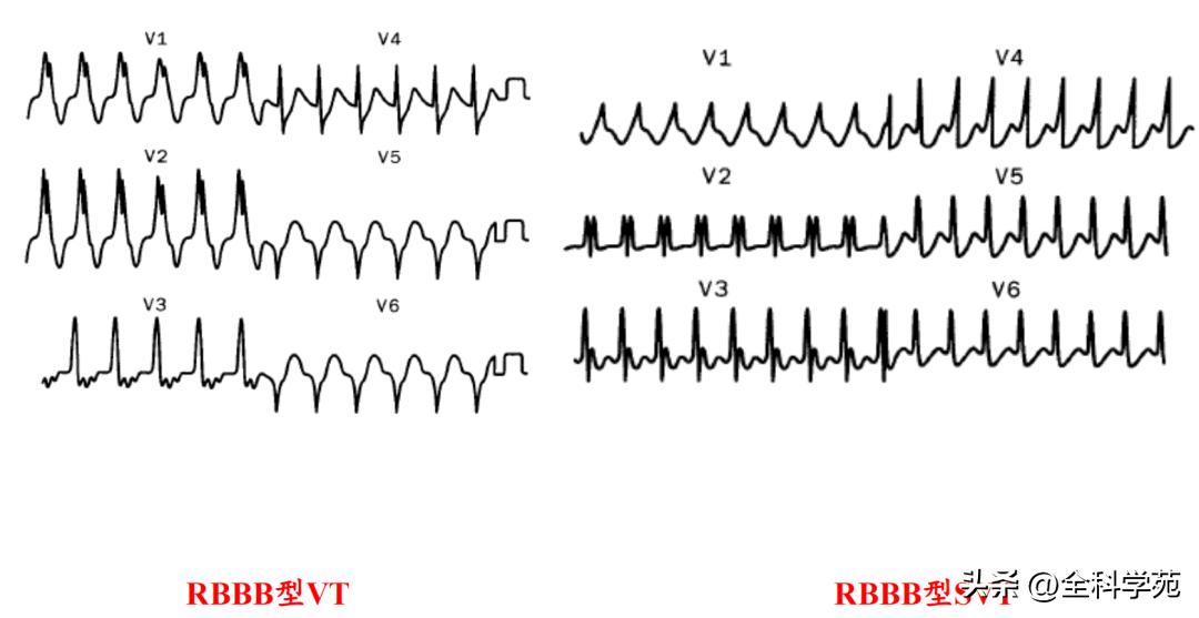 心电图上表现为宽qrs波,心电图中qrs是代表心动过速吗
