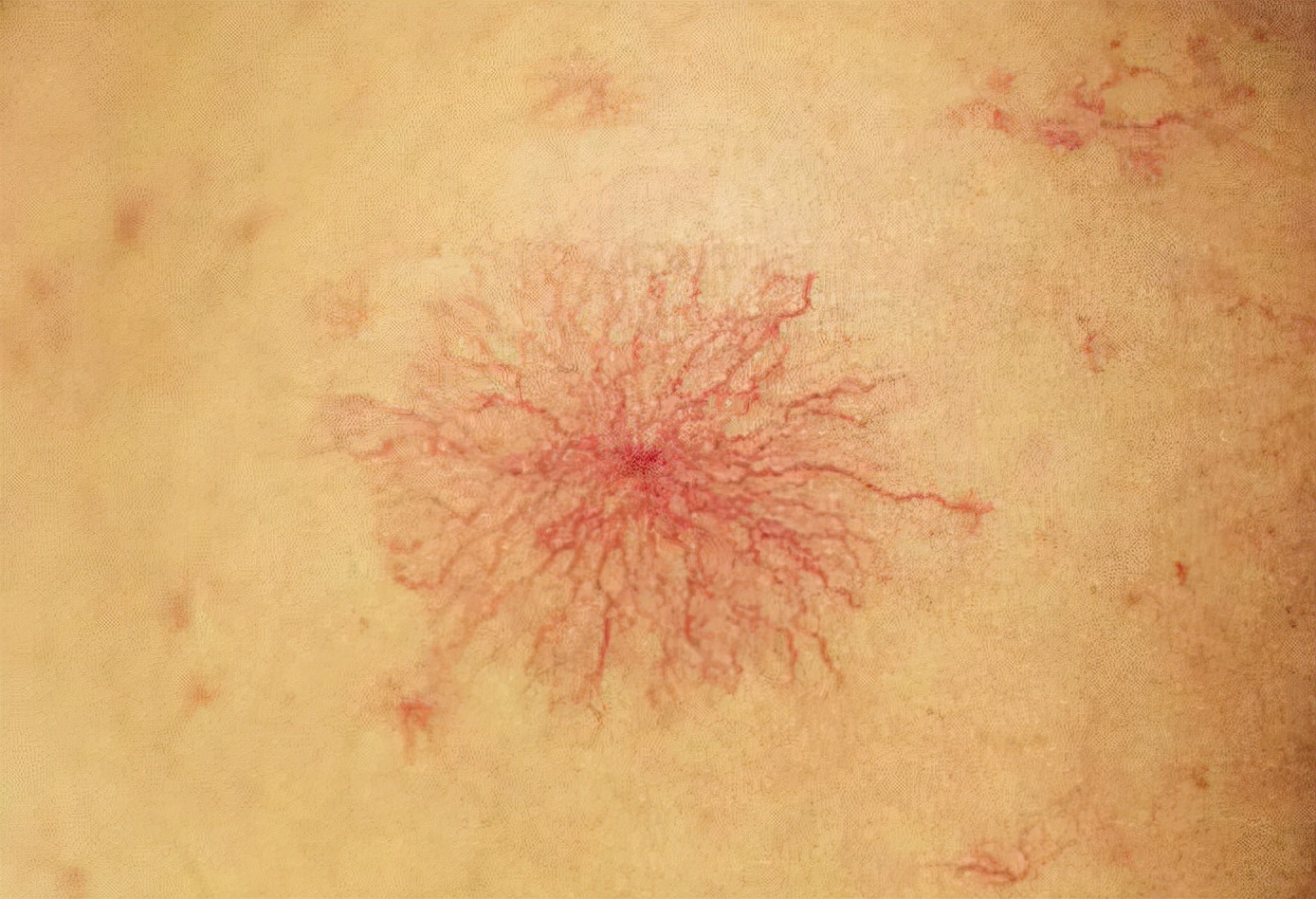 转氨酶容易升高的人注意哪些,转氨酶170左右怎么护肝降低转氨酶