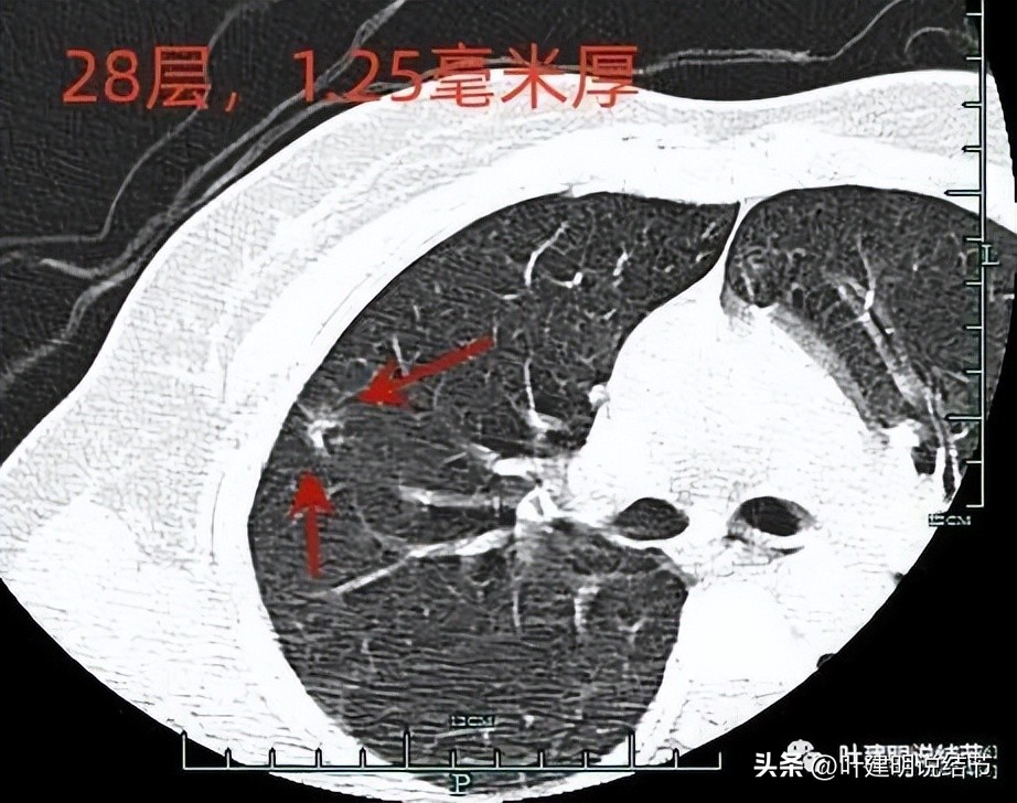 磨玻璃结节伴有增生是癌症吗,磨玻璃结节会是别的癌转移的吗
