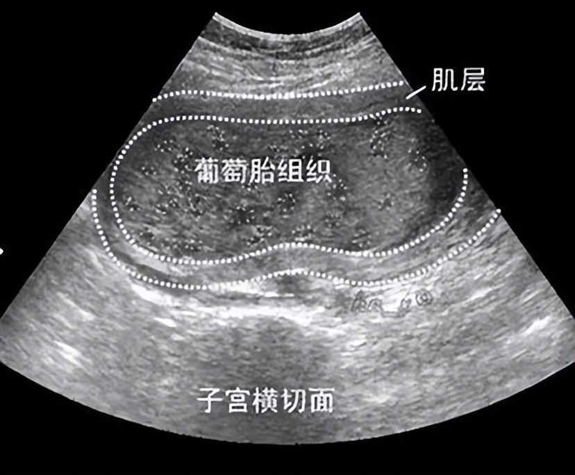 怀孕吐得厉害跟孩子智商有关吗,怀孕时吐得厉害