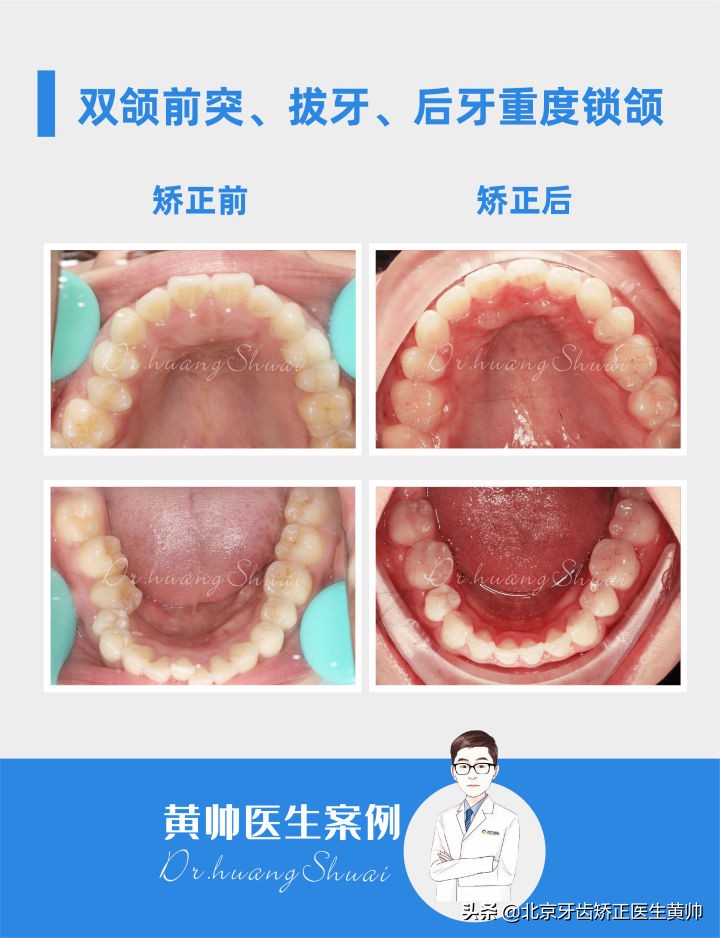 嘴凸的人怎么笑起来好看,嘴凸怎么让自己不焦虑