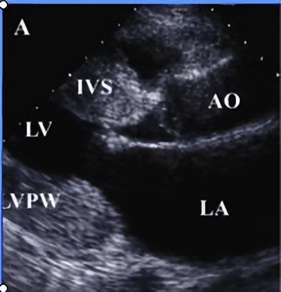 扩张型心肌病之科普小问答四,扩张型心肌病之科普四