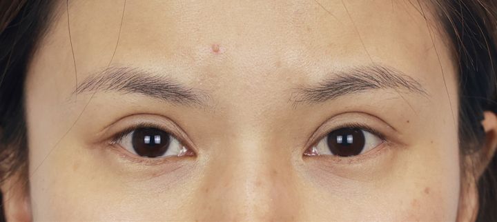 修复假宽深双眼皮最好的医院,双眼皮做宽了显老怎么补救