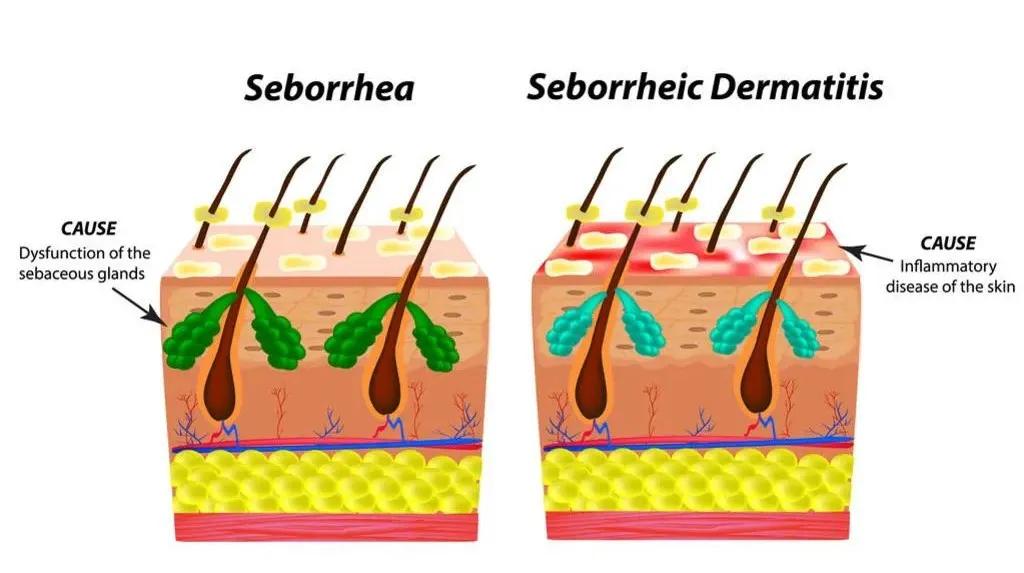 头屑多可能是脱发前兆,皮肤科医生头皮痒头屑多怎么解决