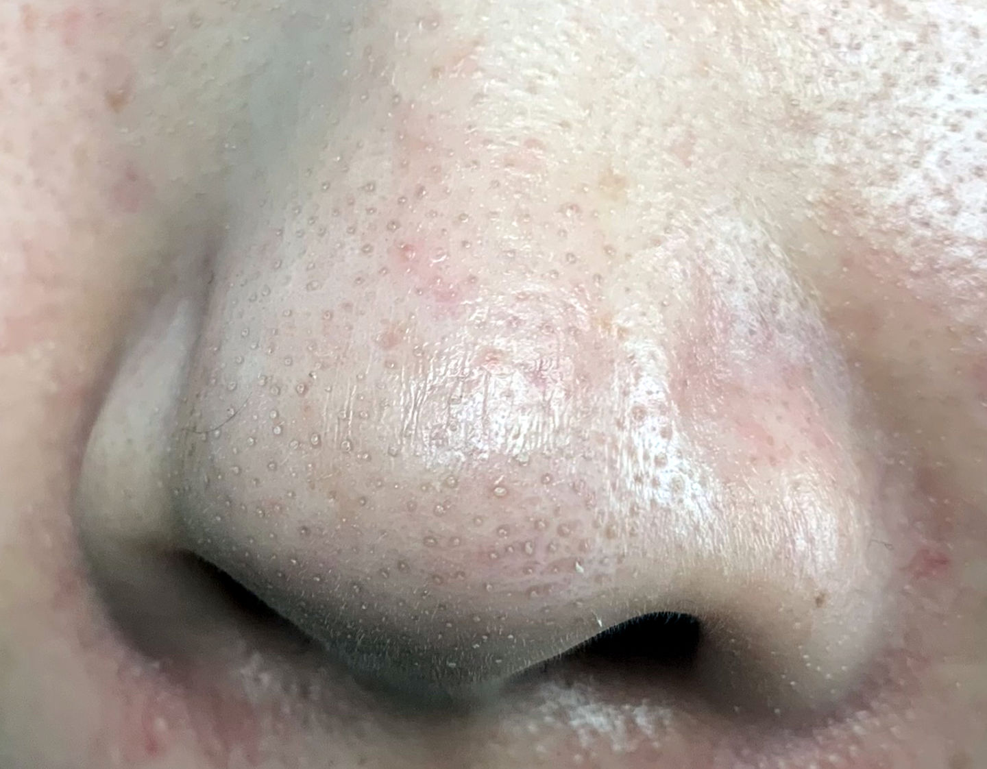 额头眉心发红有闭口粉刺,眉心鼻头频繁起粉刺怎么办