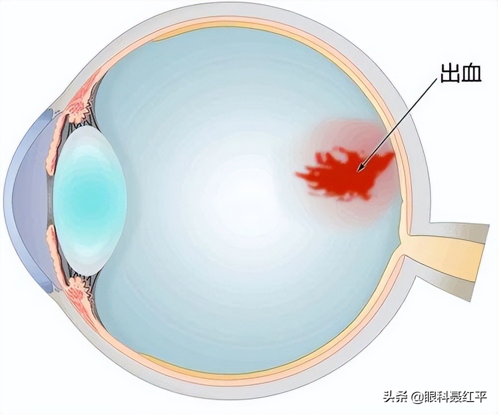 高血压眼底出血打针6000一针,高血压眼底出血视力模糊能恢复吗