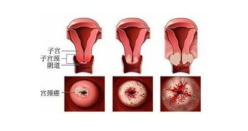 宫颈癌正确冲洗方法,宫颈癌患者治愈后需要经常冲洗吗