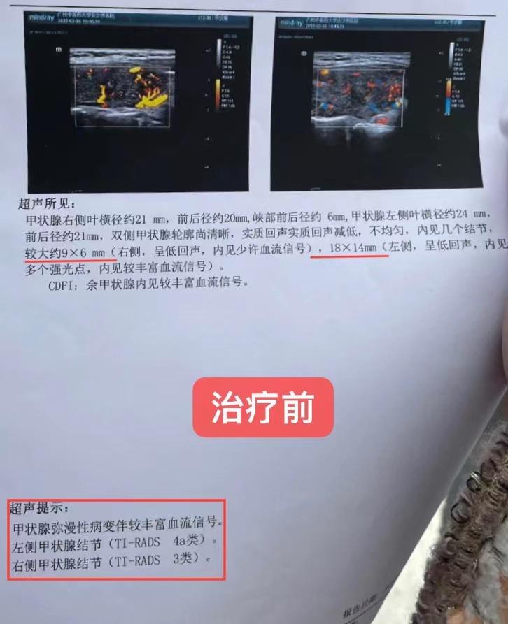 甲状腺女性比男性高发多少,甲状腺结节高发是怎么回事