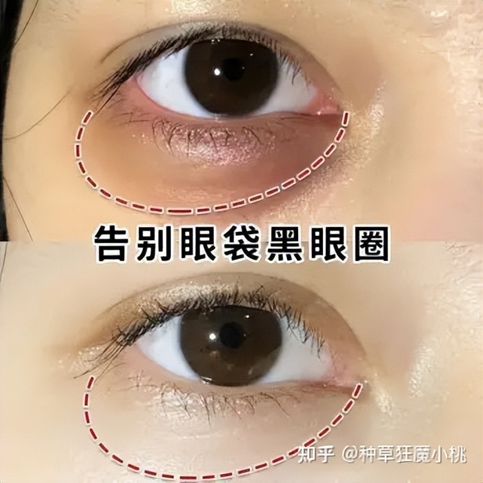 遗传的黑眼圈怎么去掉,如何去掉黑眼圈学生党