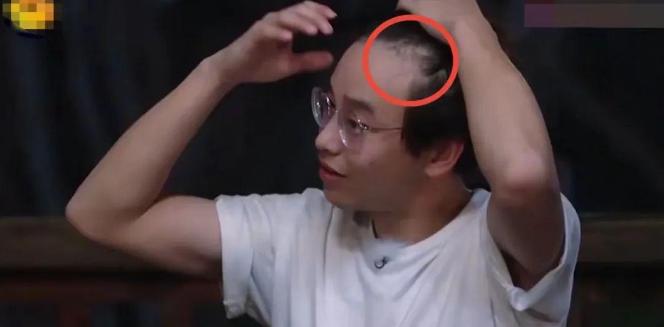 明星逃不过的脱发,明星也秃头还戴假发片